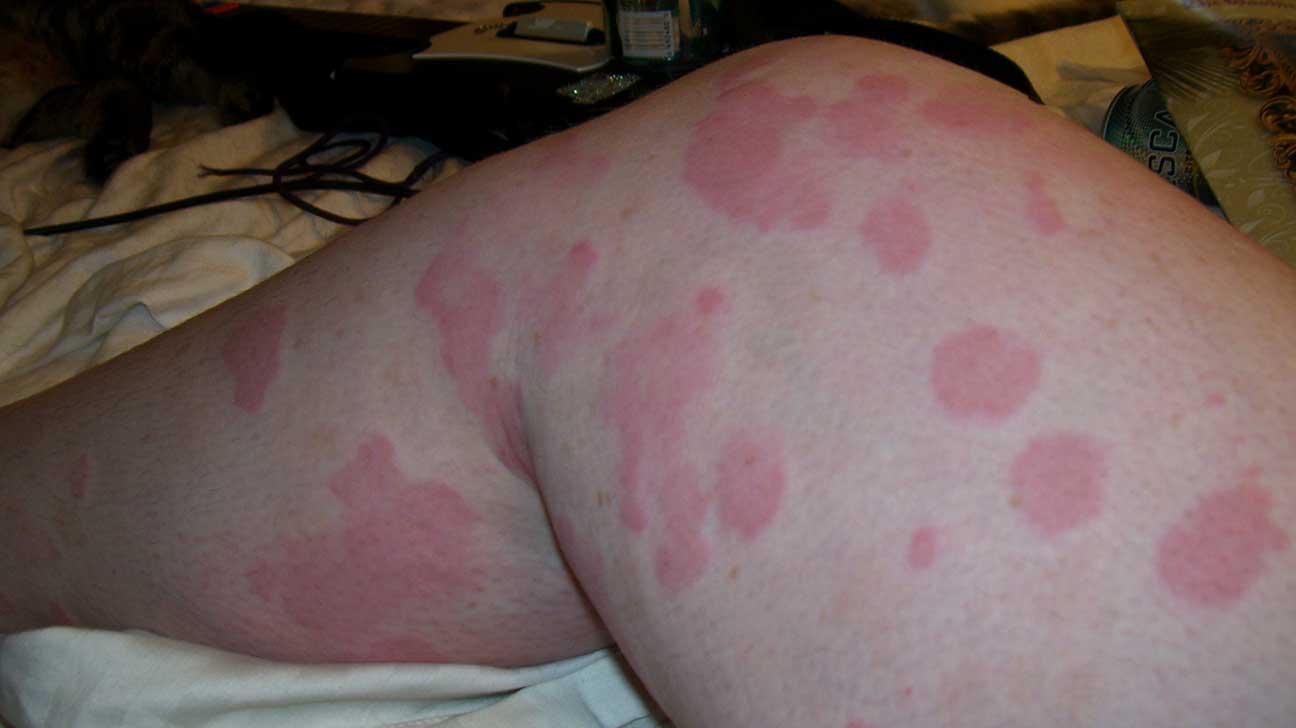 Causes Of Red Bumps And Spots On Legs