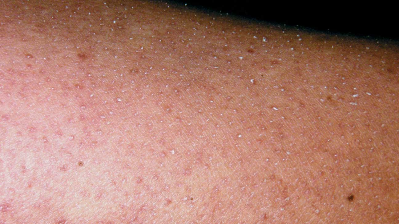 Soldat eksekverbar hybrid Causes of Red Bumps and Spots on Legs