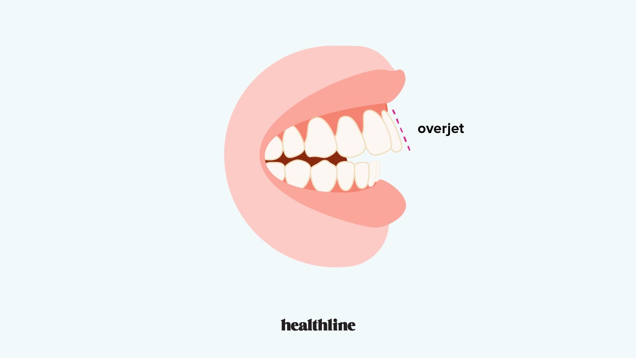 Overbite Braces Best Options, Alternative Treatments