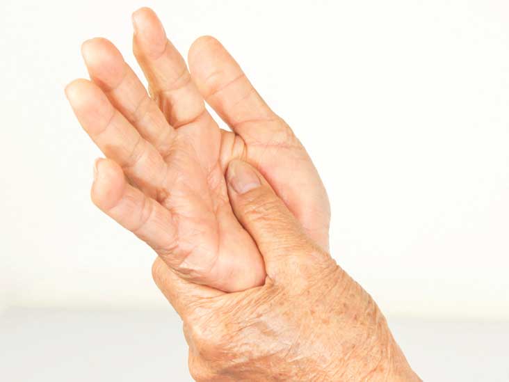 Rheumatoid arthritis stages,