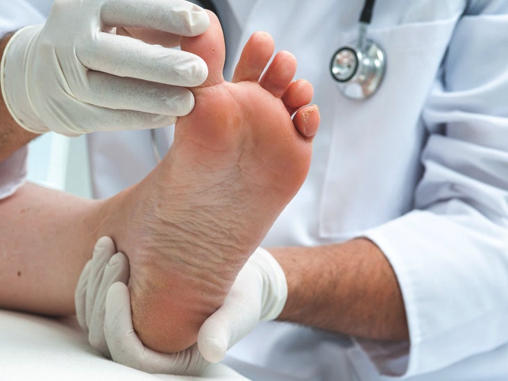 Dislocated Toe What To Know And Do