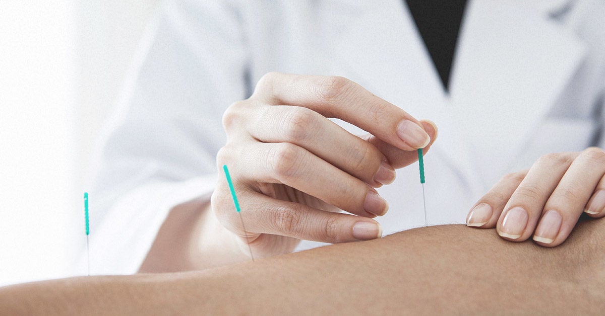 Dry Needling vs Acupuncture: Benefits and Risks