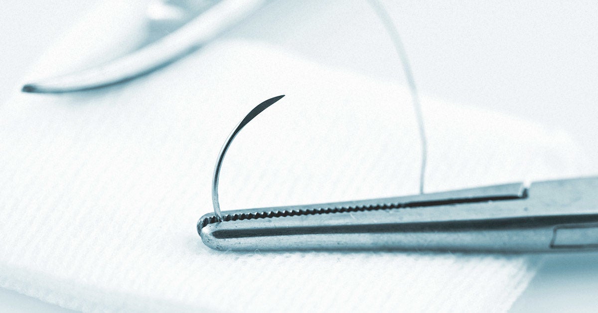 How to Remove Stitches: What to Expect