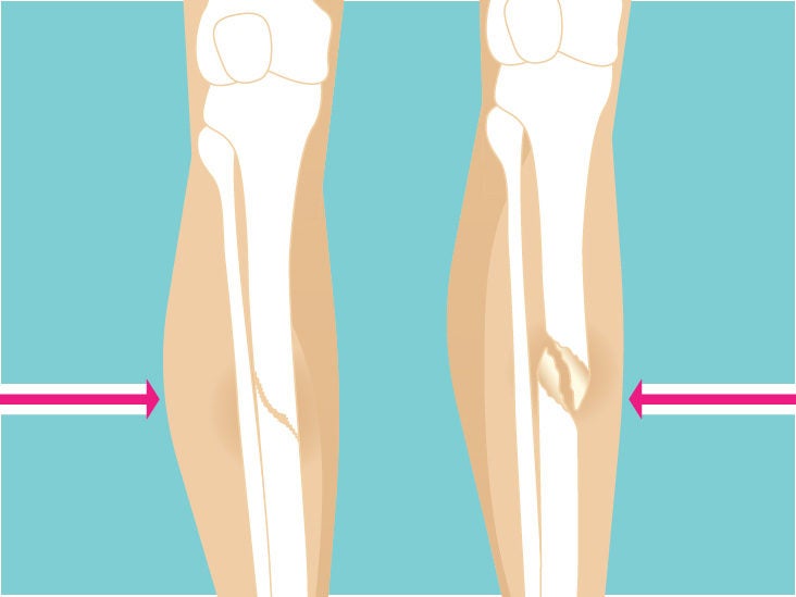 Greenstick Fracture: Causes, and More