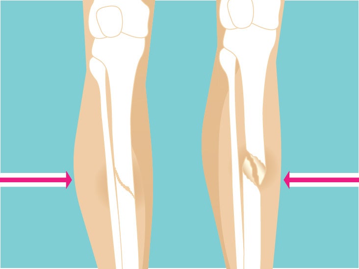 Spiral Fracture Healing Time, Tibia, and Fibula