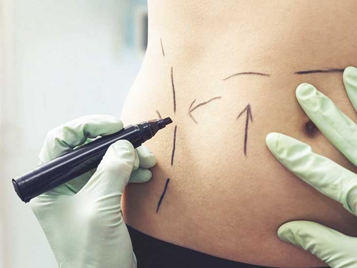 Is Liposuction Safe? What to Expect, Risks, and More