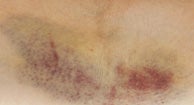 Christmas Disease Hemophilia B