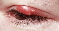 Eyelid Inflammation (Blepharitis): Causes, Symptoms, and Treatments