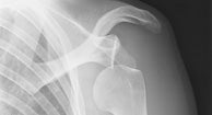 Dislocations: Causes, Diagnosis & Treatments