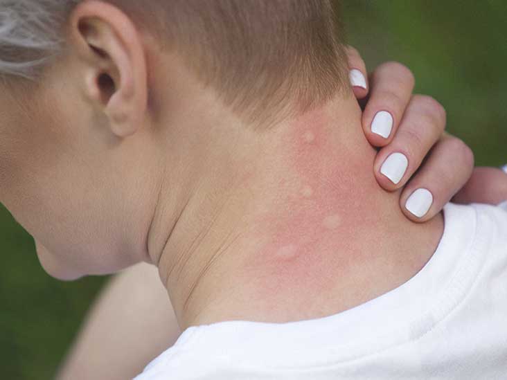 Insect Sting Allergy Basics What Are Allergies