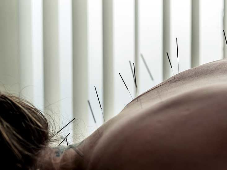 Acupuncture Encino