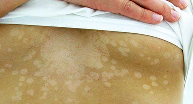 Tinea Versicolor: Causes, Symptoms, & Treatment