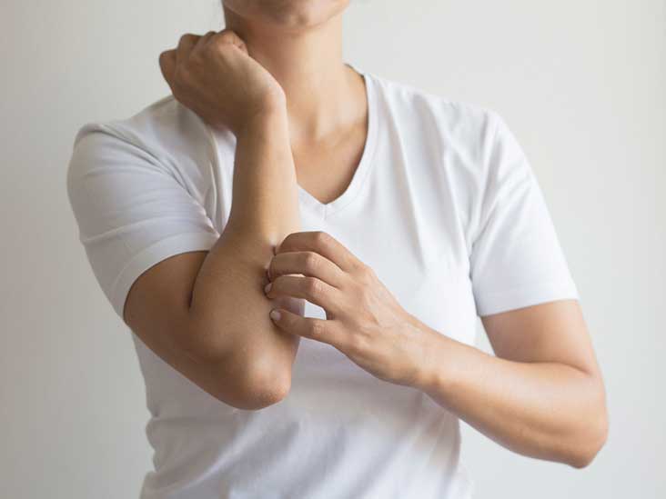 Are Hives Contagious Types & Prevention Methods