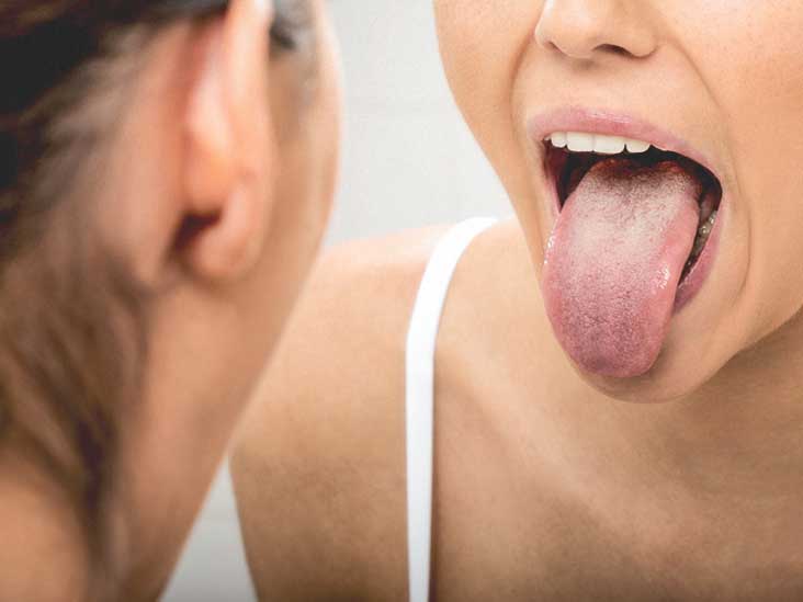 Hpv tongue base cancer