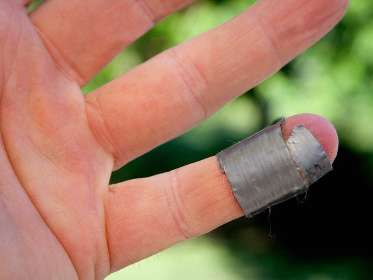 removing warts on hands with duct tape