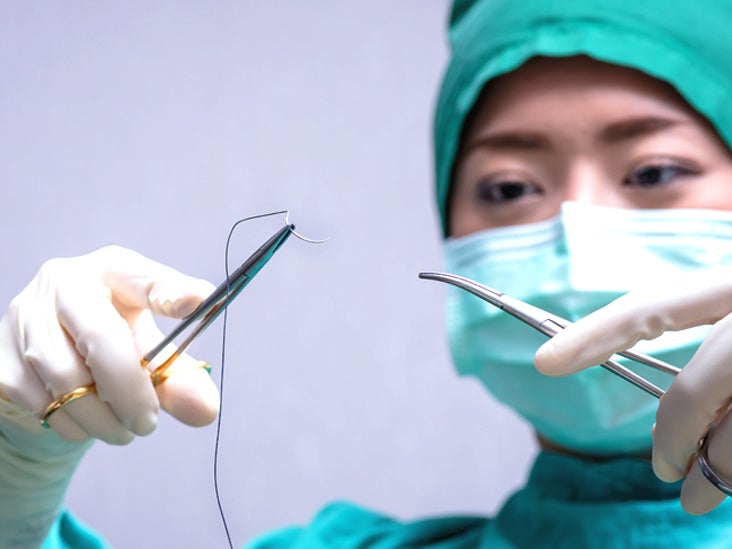 Surgical Suture: Types, Vs. Stitches, More