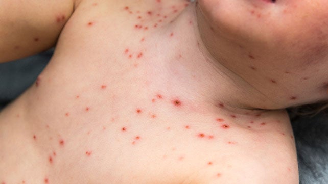 Chickenpox: Overview, Causes, and Symptoms