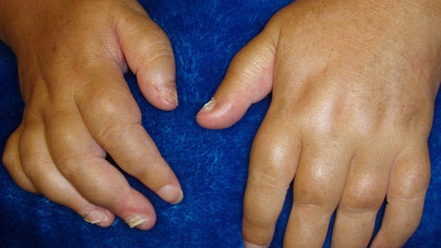 arthritis psoriatica sintomas