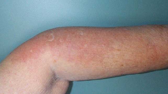 Rheumatoid Arthritis Rashes: Pictures, Symptoms, and Treatments