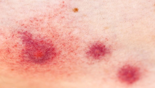 Allergic reaction symptoms to insect bites