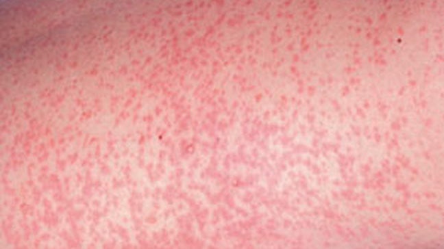 german-measles-rubella-causes-symptoms-and-treatments