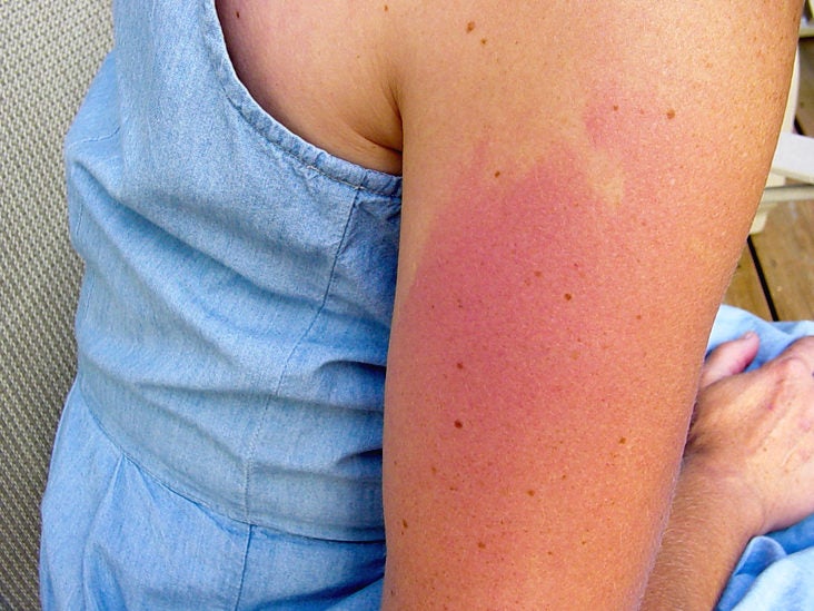 Sun Rash: Poisoning, Treatment, Causes, Pictures, and More