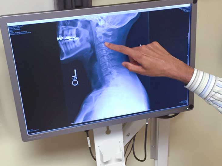 barium swallow test