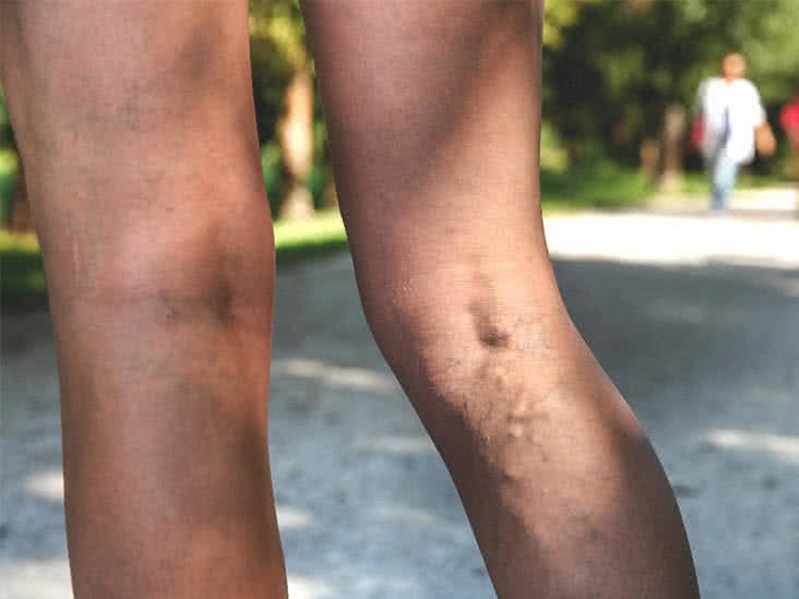 varicose bruise picioare)