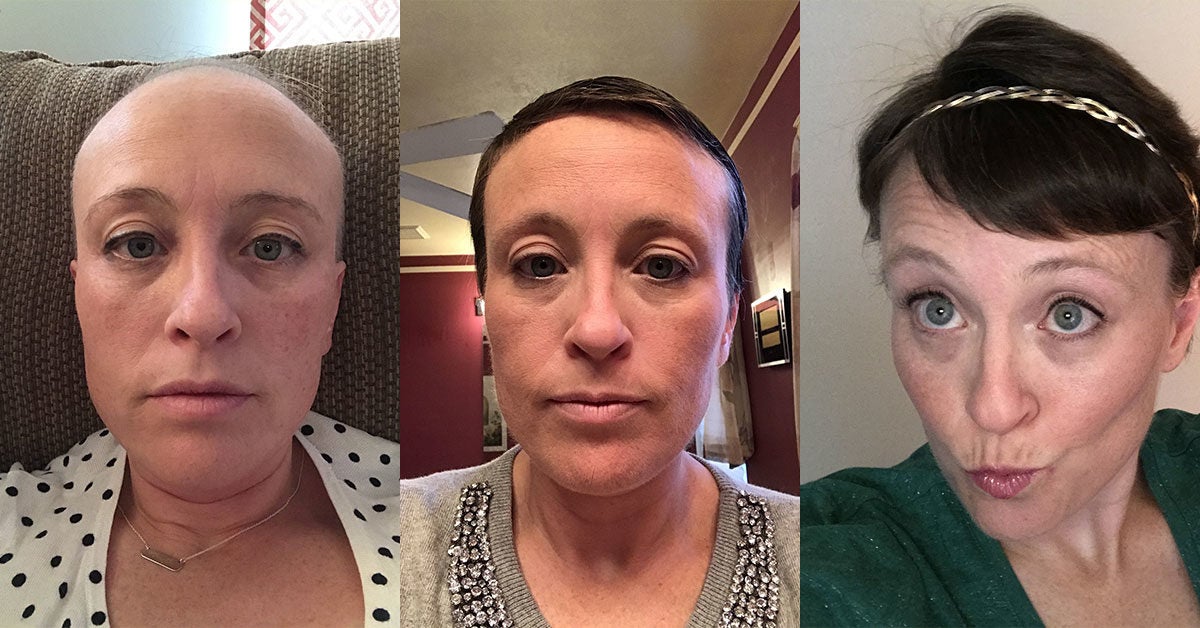 Chemotherapy Hair Loss Timeline 