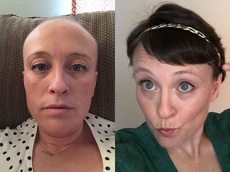 My Chemotherapy Diary 52 Photos Of Hair Loss And Recovery