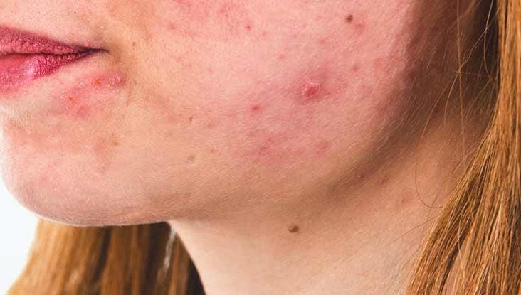 Hair Loss on Accutane and How to Prevent It