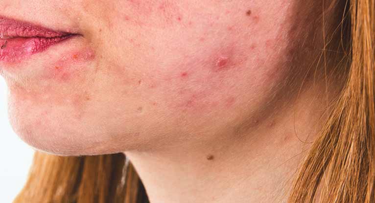 Berri klik Lege med Accutane Side Effects: What Are They?