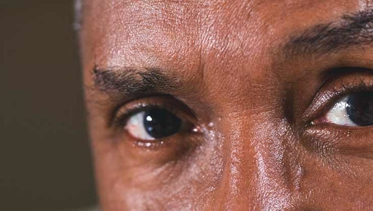 Eye Stroke Symptoms Causes And More