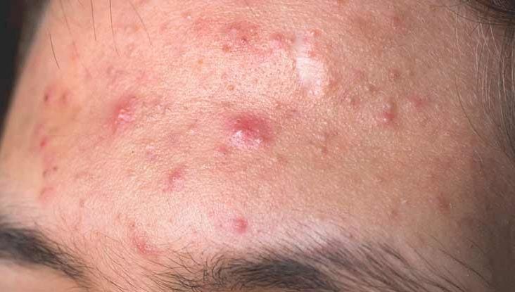 Blind Pimples: They Are and to Rid of Them