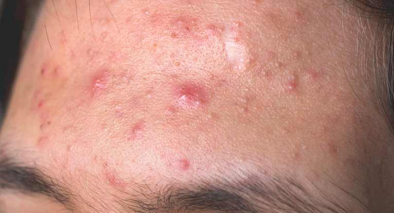 how-do-pimples-form-causes-types-and-more