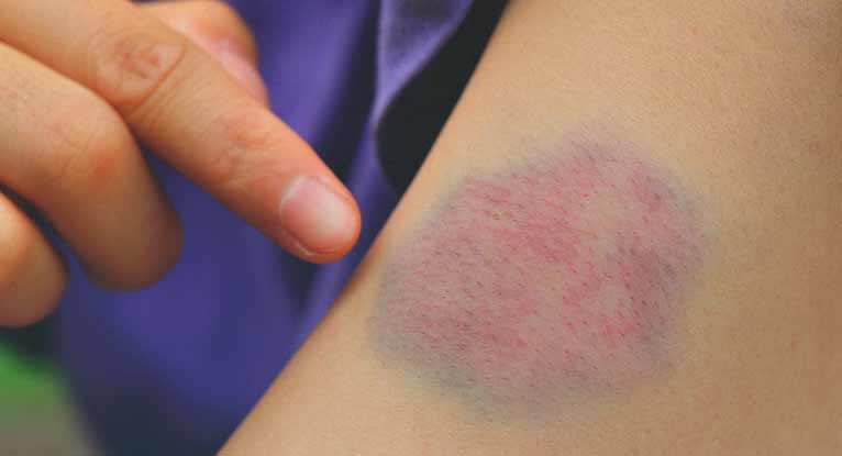varicose bruise)
