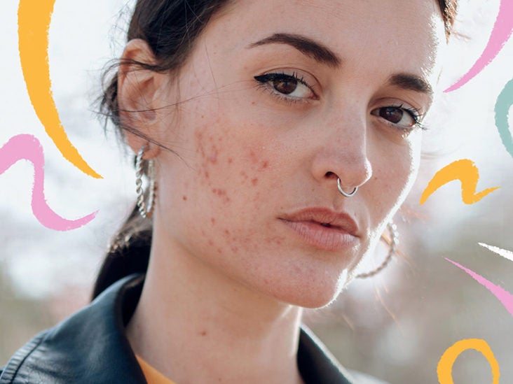 The Best Way to Heal Acne from Anxiety and Depression