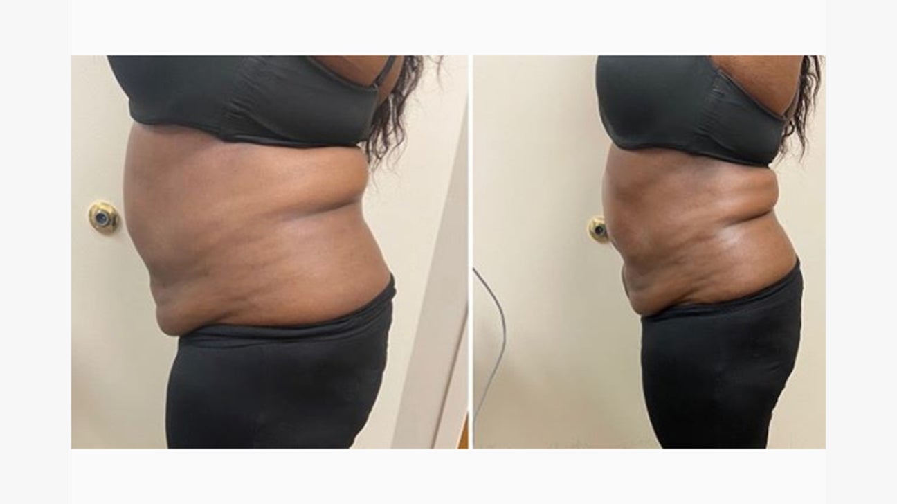 How Cavitation Removes Fat And Aids Your Body Slimming Goals - SlimSpa