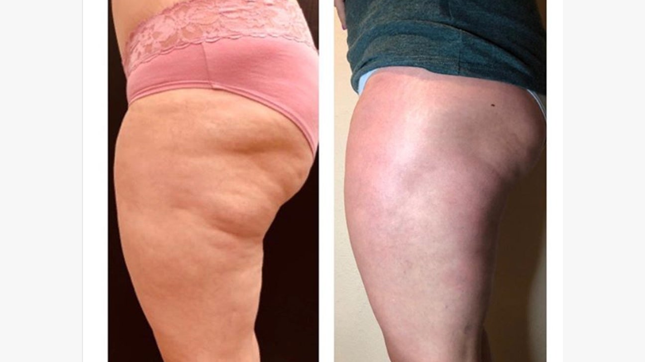 Does fat cavitation really work?