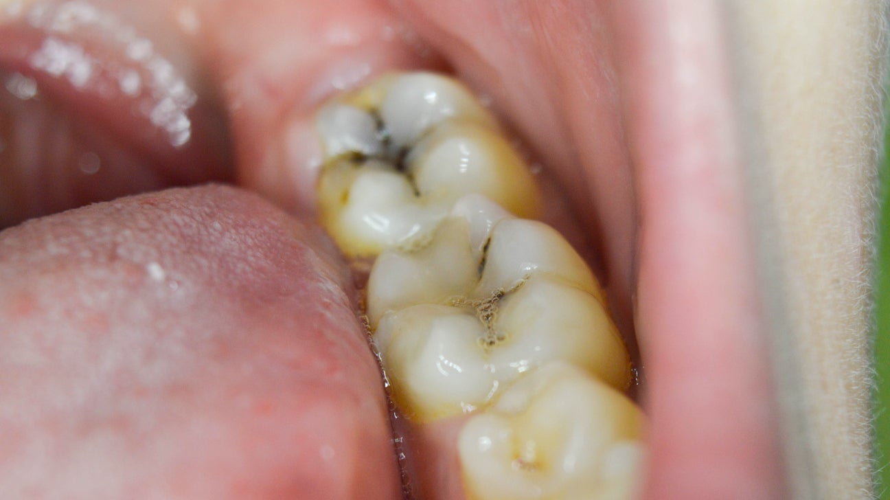 How Do You Know if Your Tooth is Rotten?