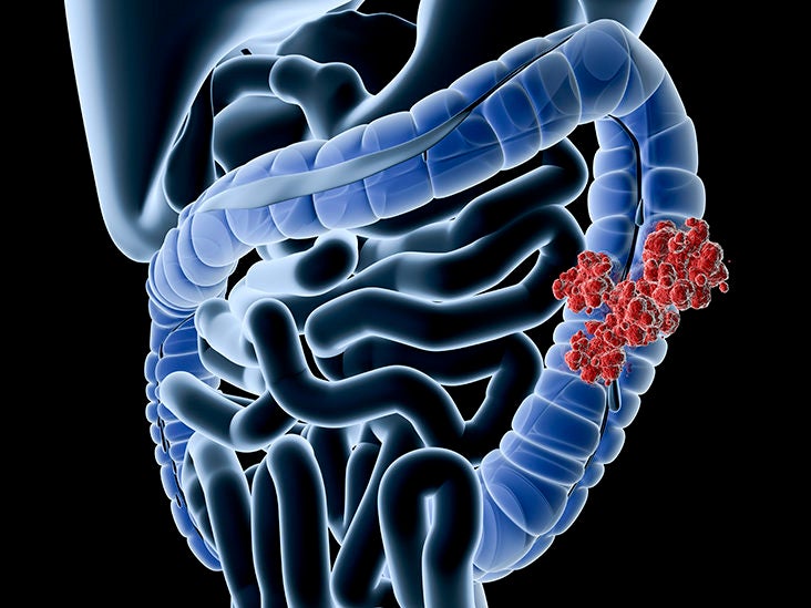 sintomas del cancer de colon en hombres)