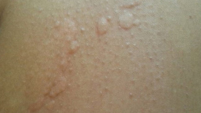 What is the symptom of hives