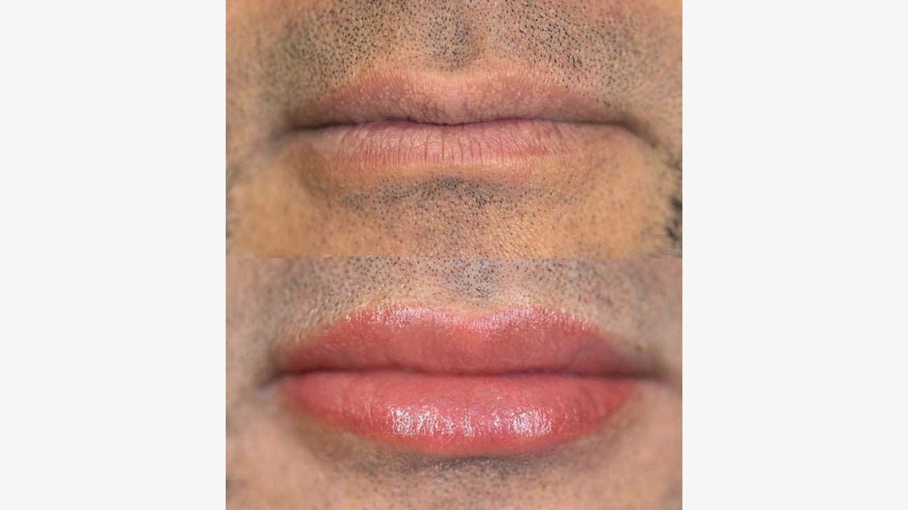 Lip Blushing Tattoo Procedure, Benefits, Side Effects, Pictures