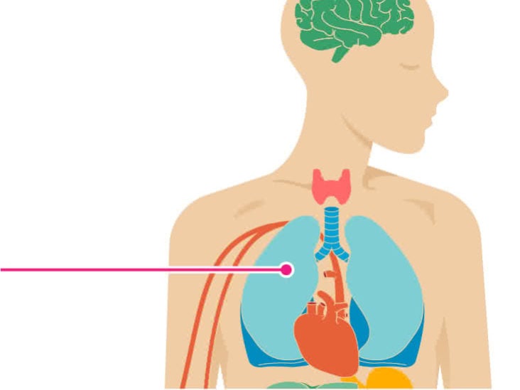 The Effects Of Pneumonia On The Body