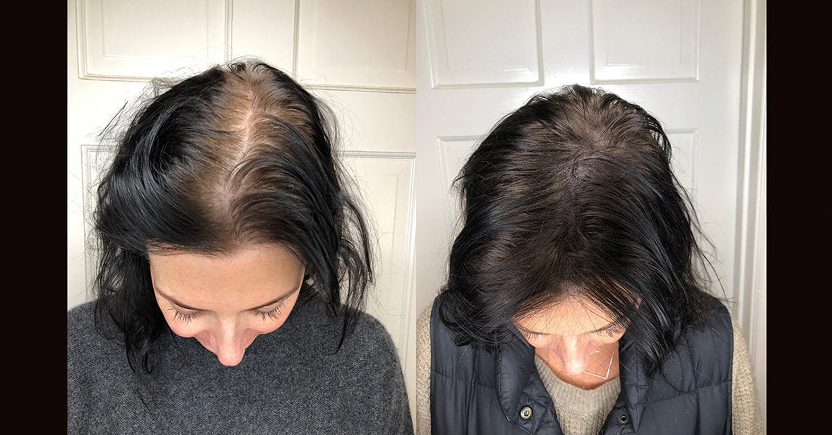 scalp micro pigmentation