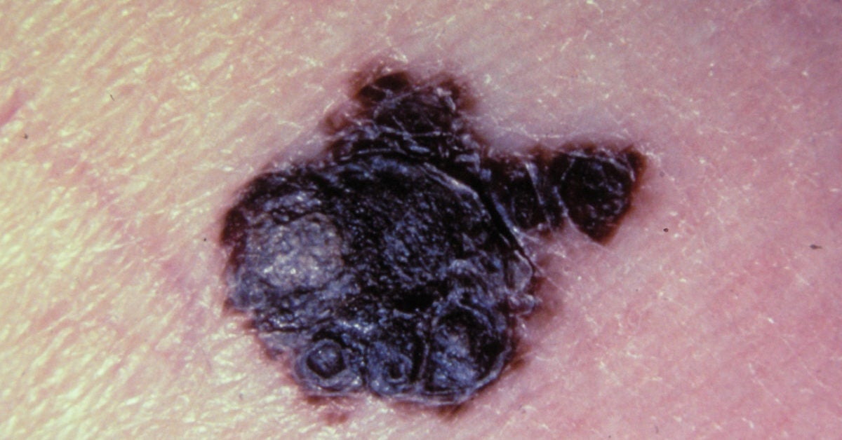 A melanoma look what like does What Does