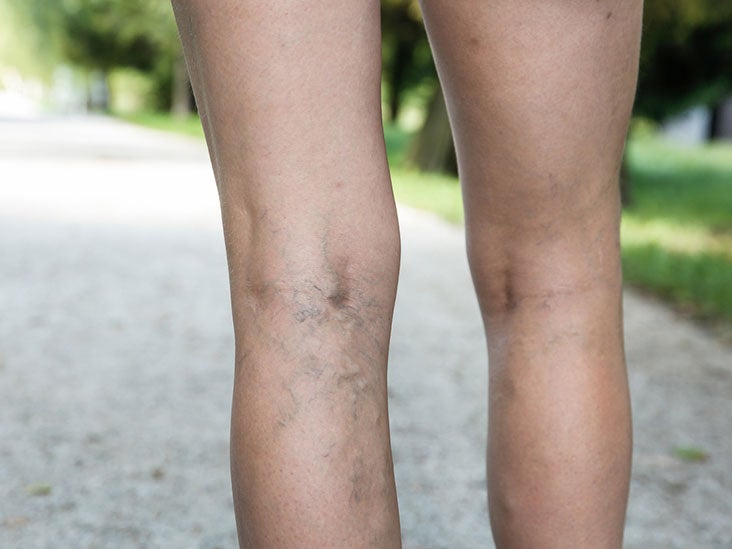 Varicose (Spider) Veins: Causes, Symptoms, and Treatments