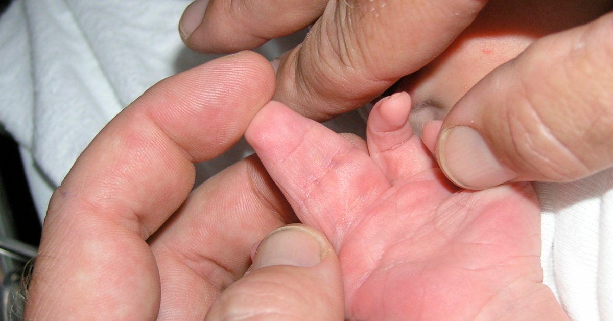 webbed fingers
