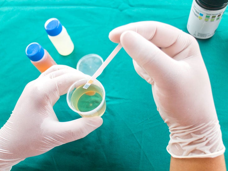 Bilirubin Urine Test Procedure Preparation And Risks 3763