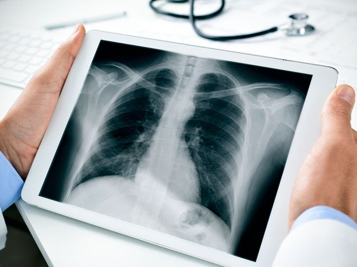 mucus in lungs x ray